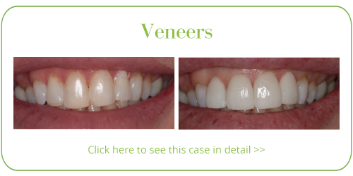 Veneers Skegness Dentist